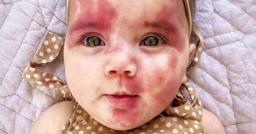 Baby With Red Birthmark Called ‘Hideous’ And ‘Defective’, But Wait till You See This Beautiful Child Now