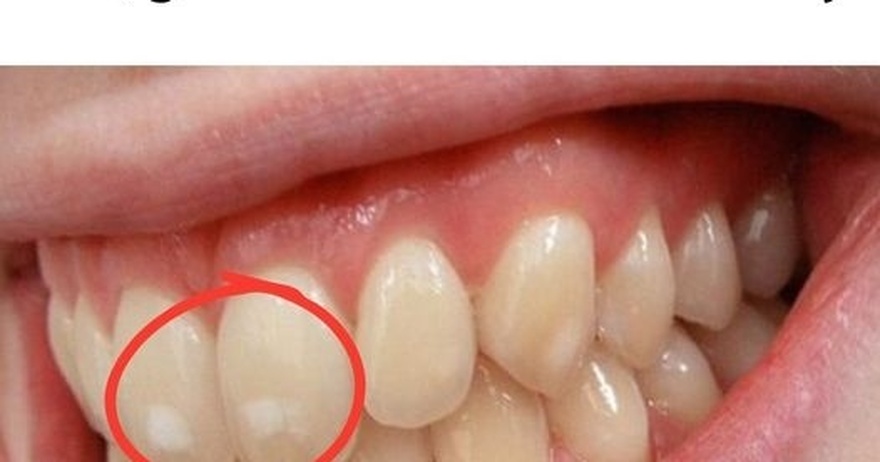 If your teeth have white spots like this, go to the dentist immediately