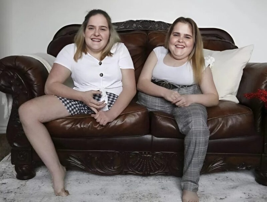 Do You Recall The Combined Sisters Born In 2002? These Sisters Were Connected At The Abdomen