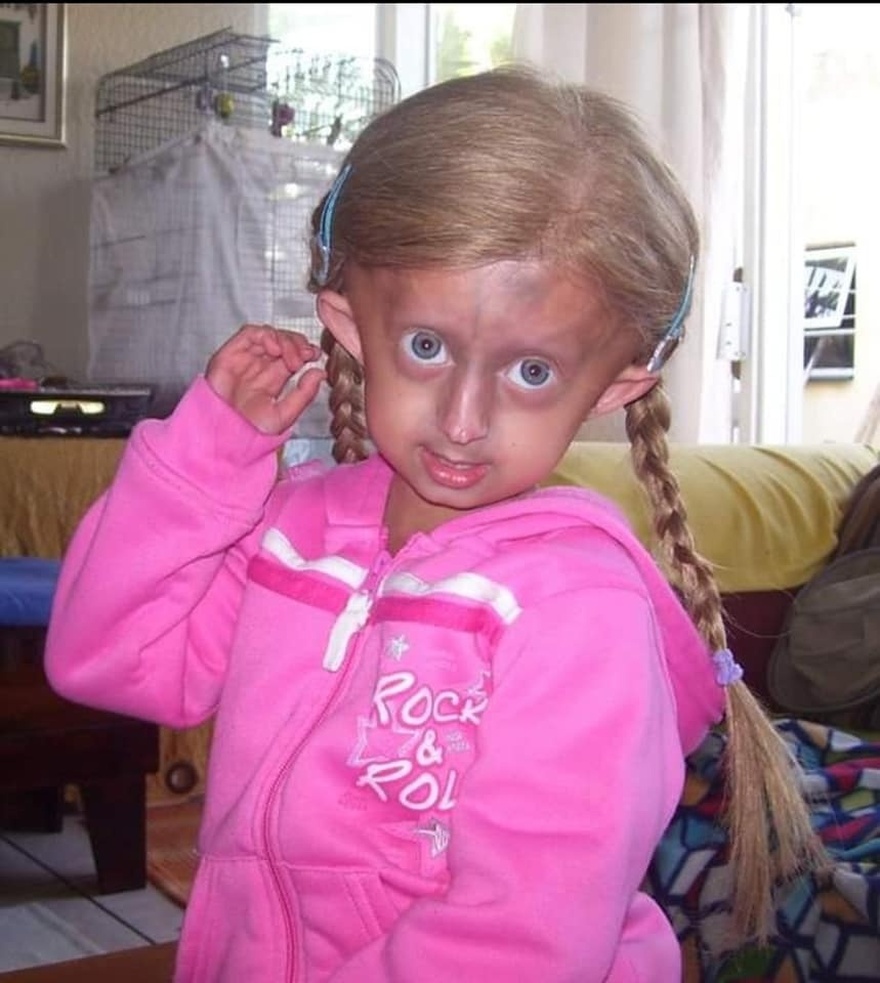 Beandri Booysen: Girl in South Africa with progeria dies