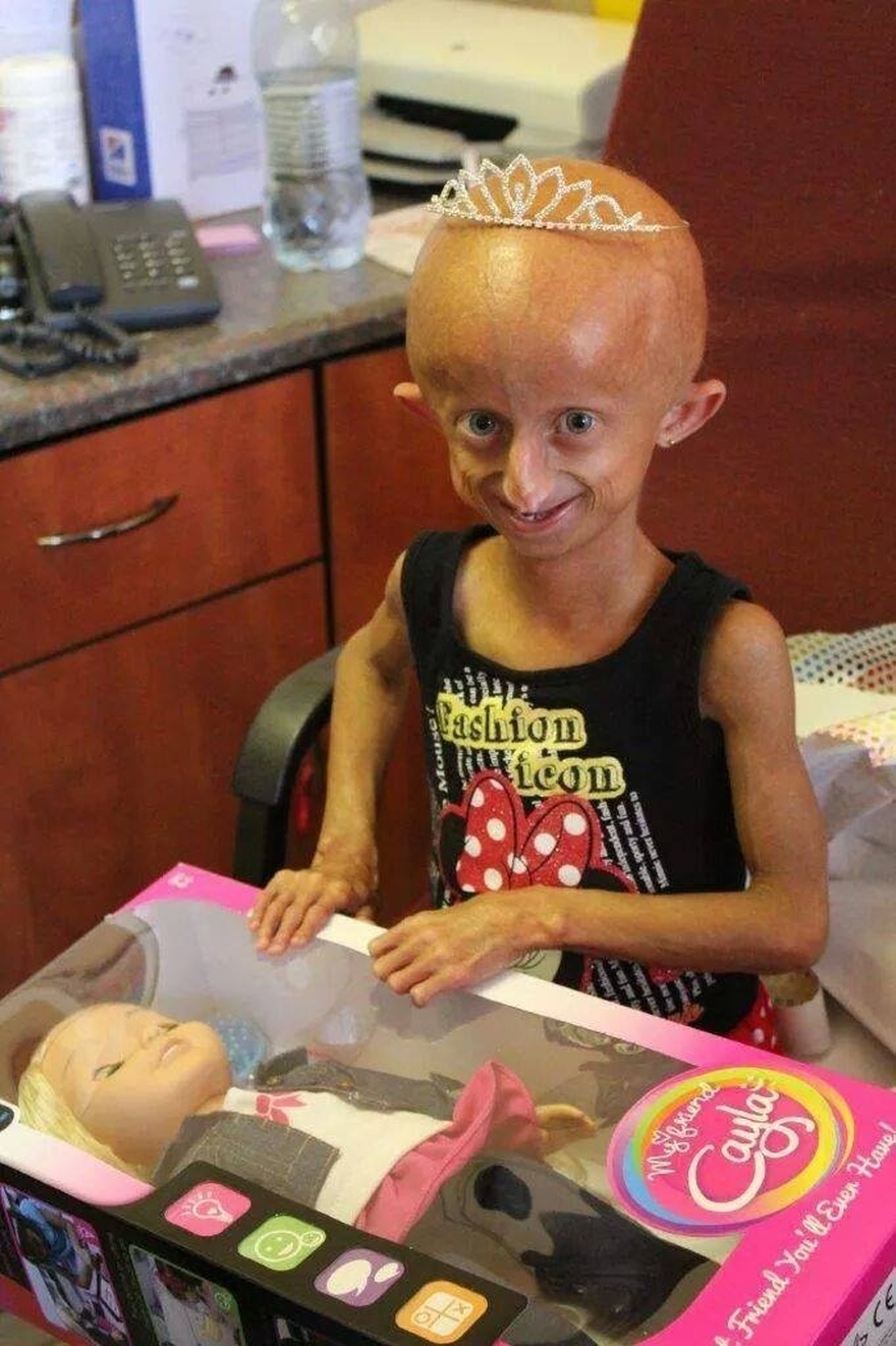 Beandri Booysen: Girl in South Africa with progeria dies