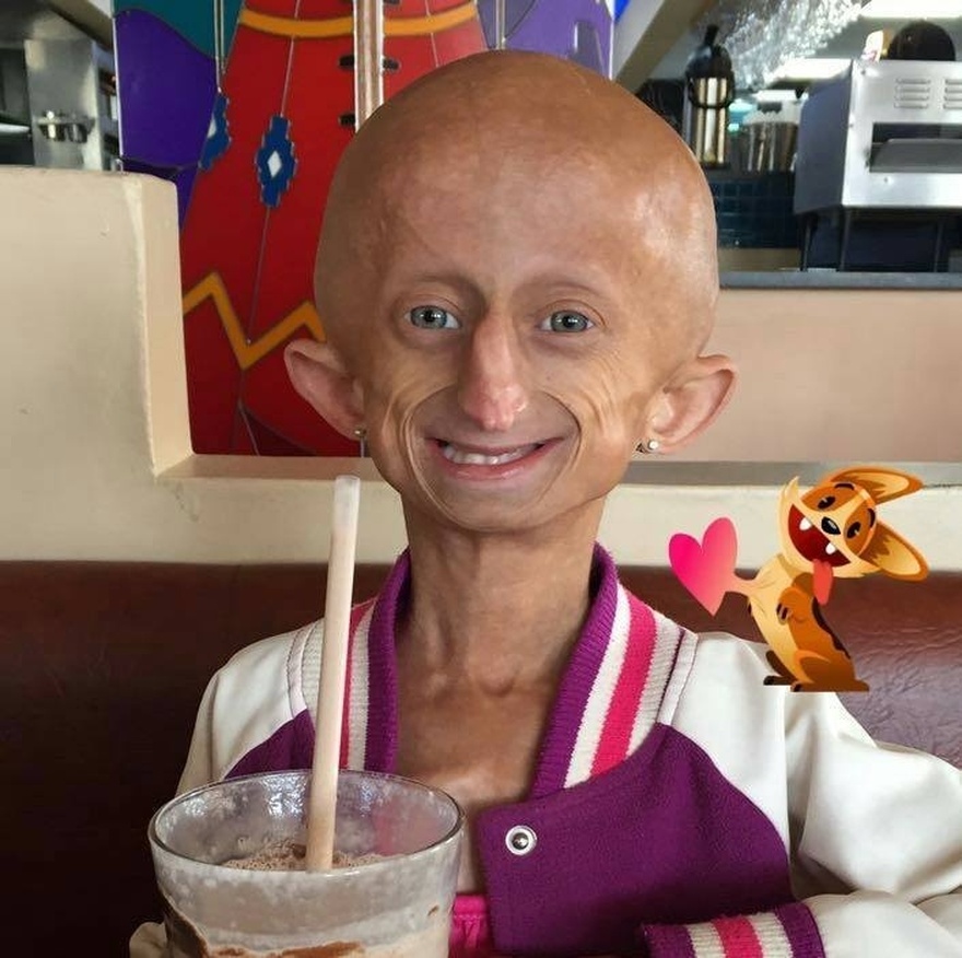 Beandri Booysen: Girl in South Africa with progeria dies