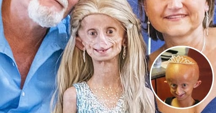 Beandri Booysen: Girl in South Africa with progeria dies