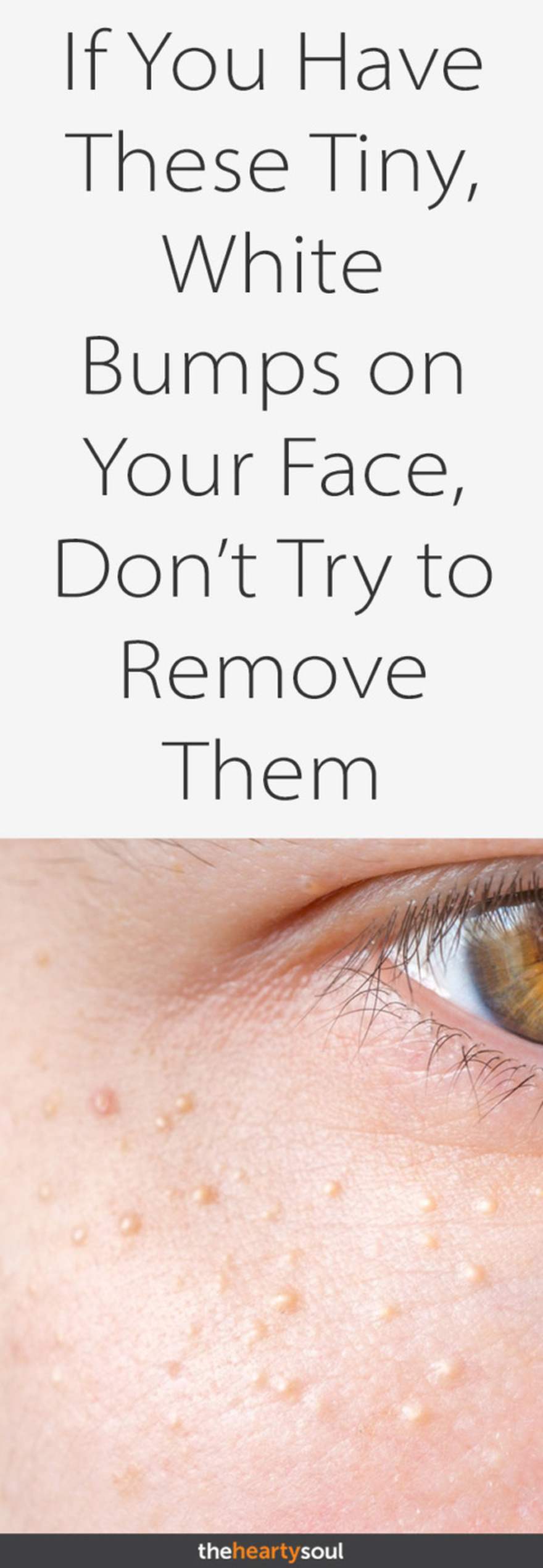 If You Have These Tiny, White Bumps on Your Face, Don’t Try to Remove Them!