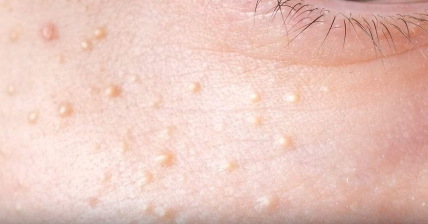 If You Have These Tiny, White Bumps on Your Face, Don’t Try to Remove Them!