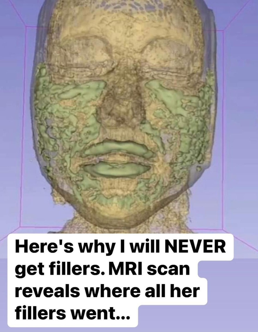 Doctor Reveals: MRI Scan Of The Face Of A 33-Year-Old Woman Reveals Where All Of Her Filler Went