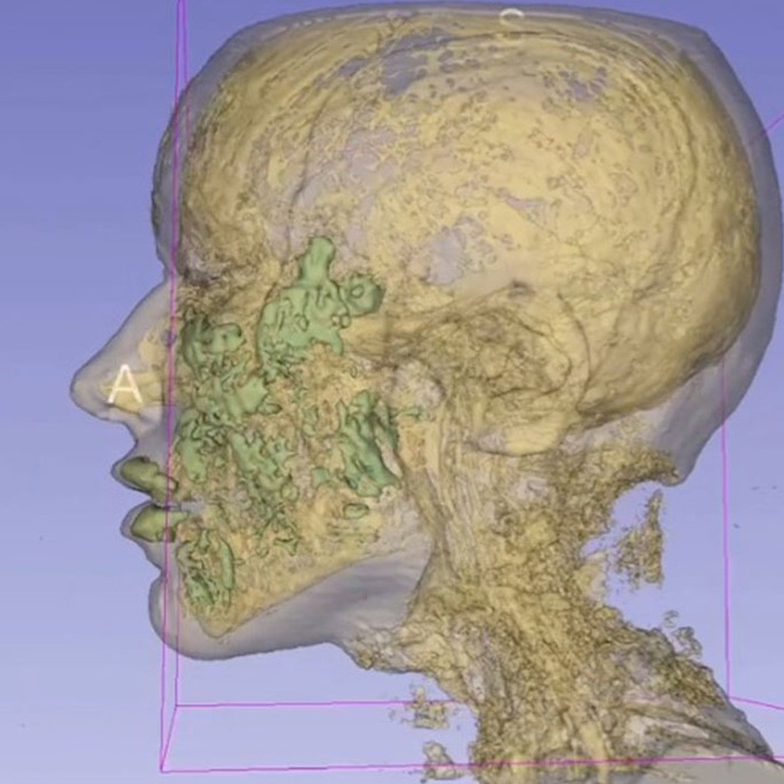 Doctor Reveals: MRI Scan Of The Face Of A 33-Year-Old Woman Reveals Where All Of Her Filler Went