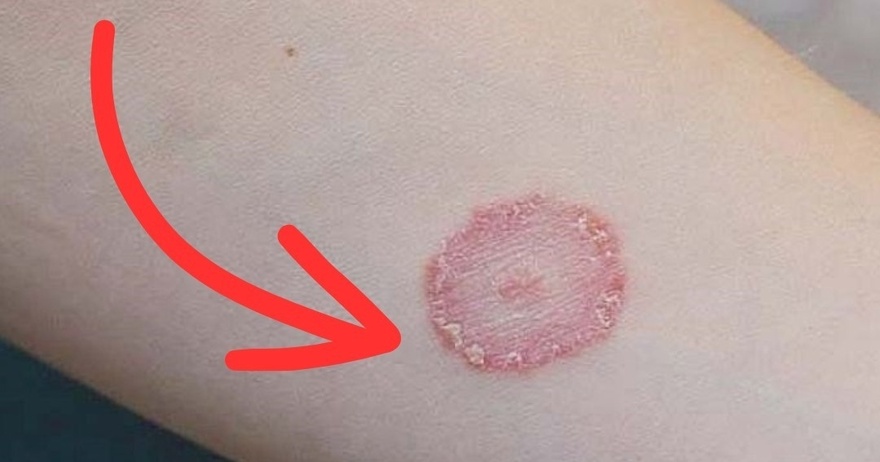 What Are These Round, Red, Itchy, Scaly Patches? Causes and Treatments