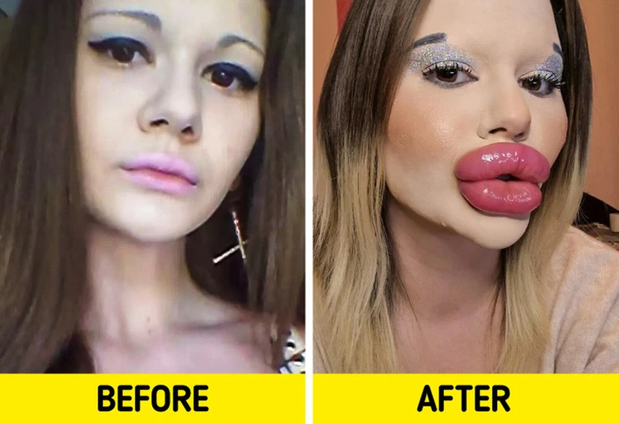 A Woman Does Injections to Look Like a Bratz Doll, Says People’s Comments Don’t Bother Her