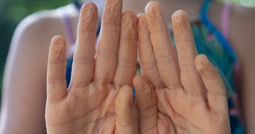 Does anyone wonder why our hands wrinkle when we stay in water for a long time?