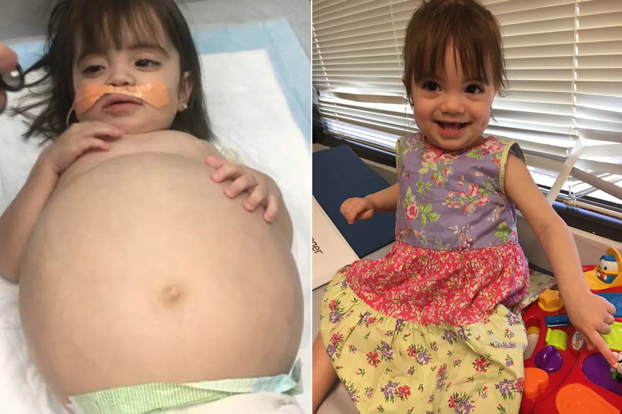 Little girl who looked 8 months’ pregnant because of deadly disease is saved thanks to dad’s kidney donation