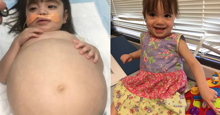 Little girl who looked 8 months’ pregnant because of deadly disease is saved thanks to dad’s kidney donation