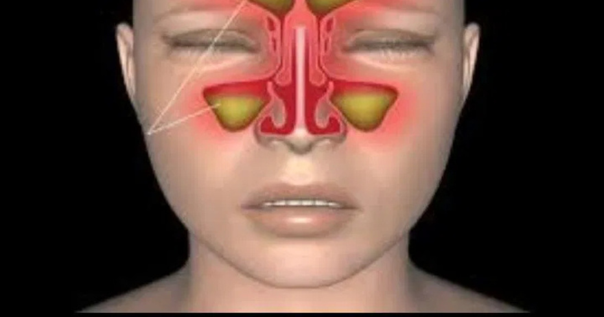 10 Natural Remedies To Help Deal With a Sinus Infection