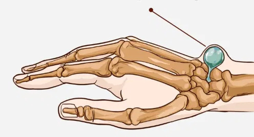 Wrist Ganglion: Causes, Symptoms, and Effective Treatments.