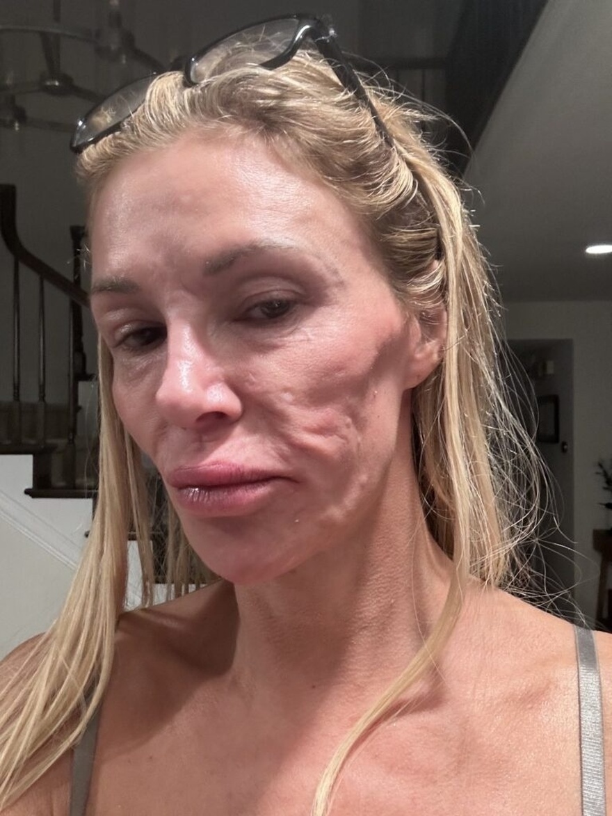 Sad truth about Brandi Glanville’s face