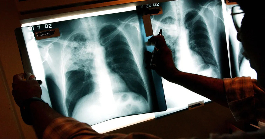 Kansas Tuberculosis Outbreak, Largest in US History, Hits 67 Active Cases Across Two Counties – Latest Details