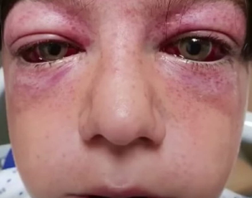 Playground craze leaves 11-year-old “looking like an alien”