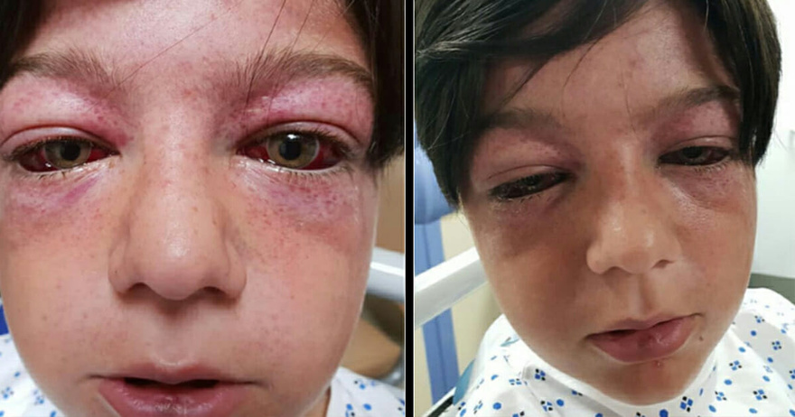 Playground craze leaves 11-year-old “looking like an alien”