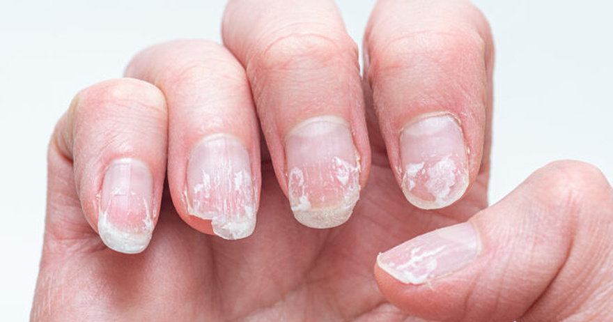 Rippled fingernails reveal secrets of possible disease