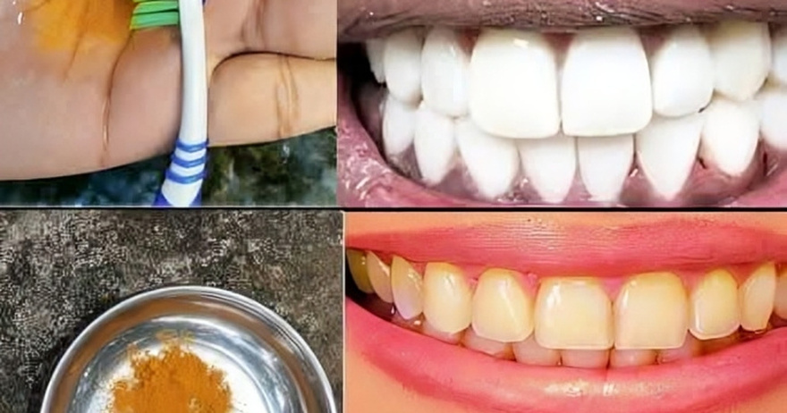 Secret That Dentists Don’t Want You to Know: Remove Tartar and Whiten Teeth Using Turmeric