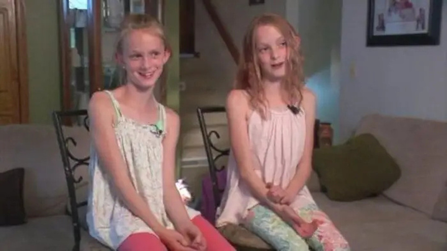 Conjoined Twins Bella And Abby Were Genuinely Associated From Birth, Yet Medical Procedure Changed Everything