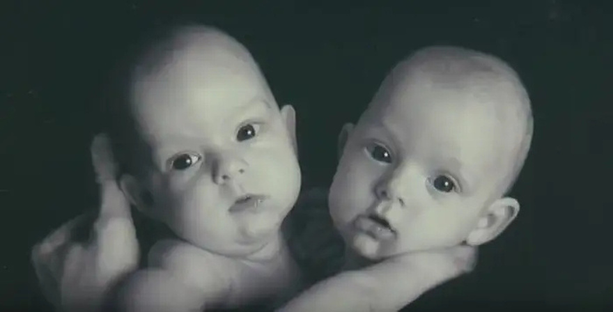 Conjoined Twins Bella And Abby Were Genuinely Associated From Birth, Yet Medical Procedure Changed Everything