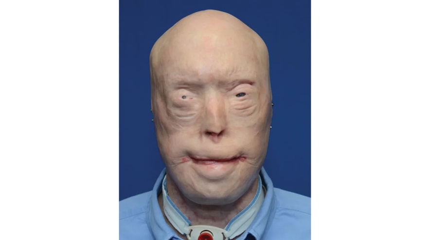 Patrick Hardison Received A New Face After Third-degree Burns, This Is Him Today