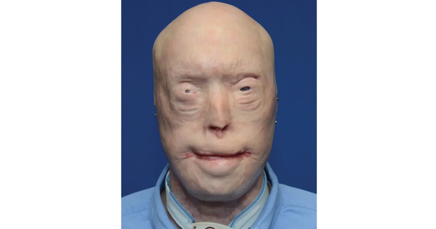 Patrick Hardison Received A New Face After Third-degree Burns, This Is Him Today