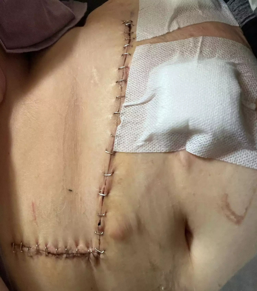 Newlywed, 27, Lied to Get a Colonoscopy. It Caught Stage 4 Cancer — After Doctors Had Dismissed Her Symptoms