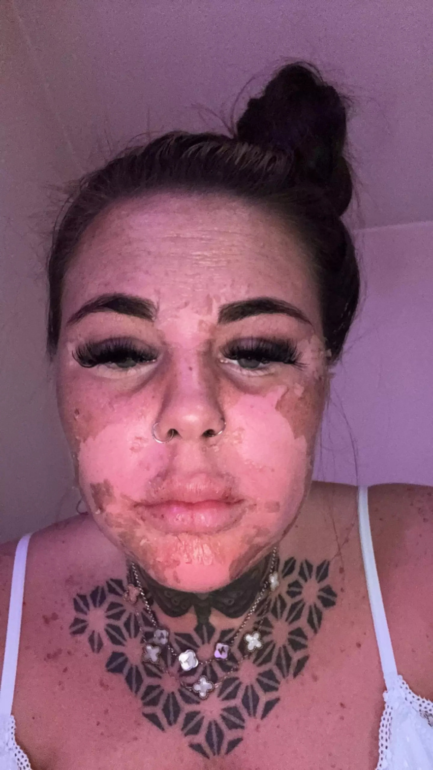 Influencer left horrified after accidentally burning skin off face while attempting ‘dangerous’ sunbed hack