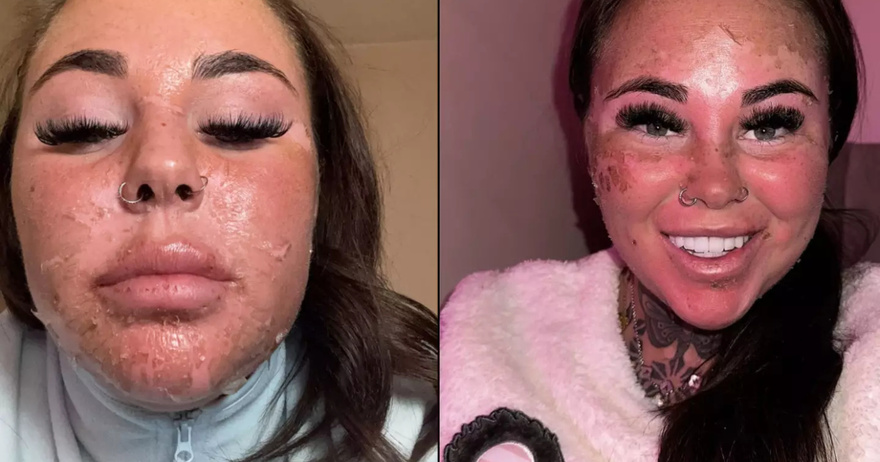 Influencer left horrified after accidentally burning skin off face while attempting ‘dangerous’ sunbed hack