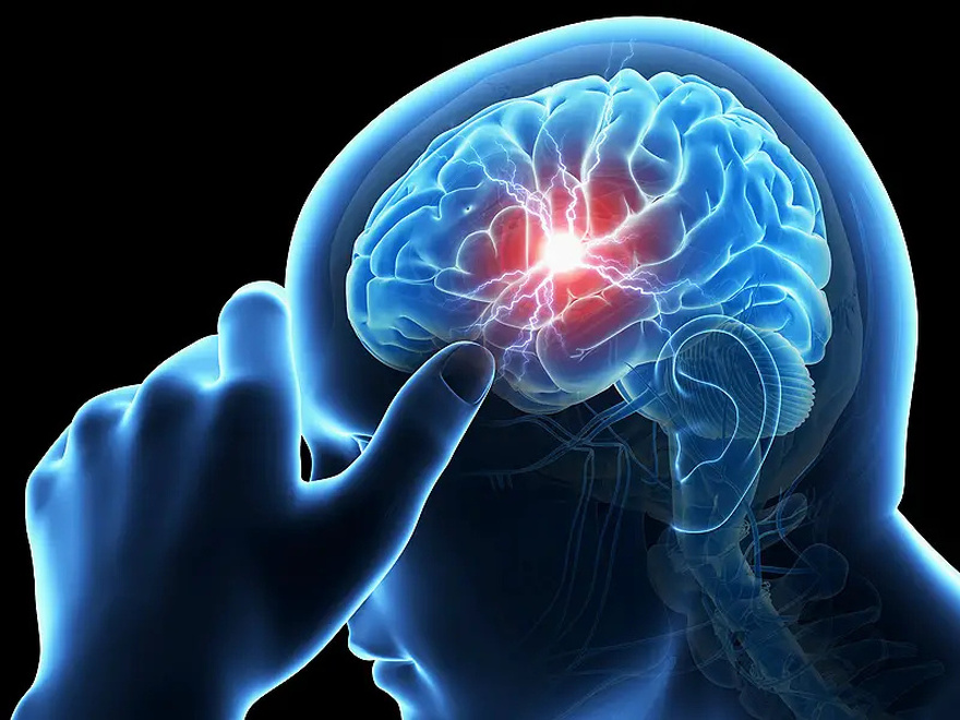 A Month Before a Stroke: Know the Warning Signs