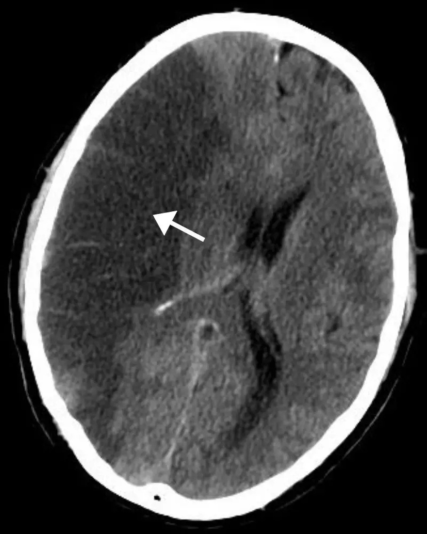 A Month Before a Stroke: Know the Warning Signs