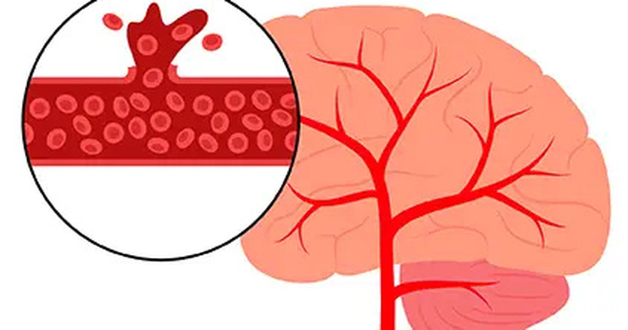 A Month Before a Stroke: Know the Warning Signs