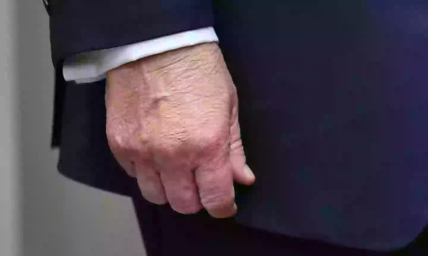 New marks ‘appear’ on Donald Trump’s hands days after large bruise sparked health fears