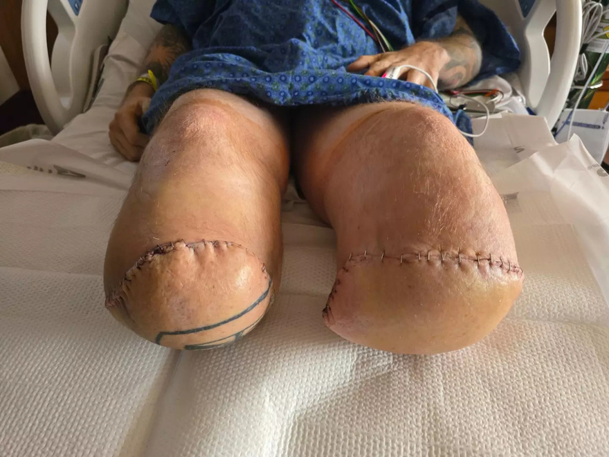 Man who burnt thumb while cooking shocked to wake up and find both his legs needed to be amputated